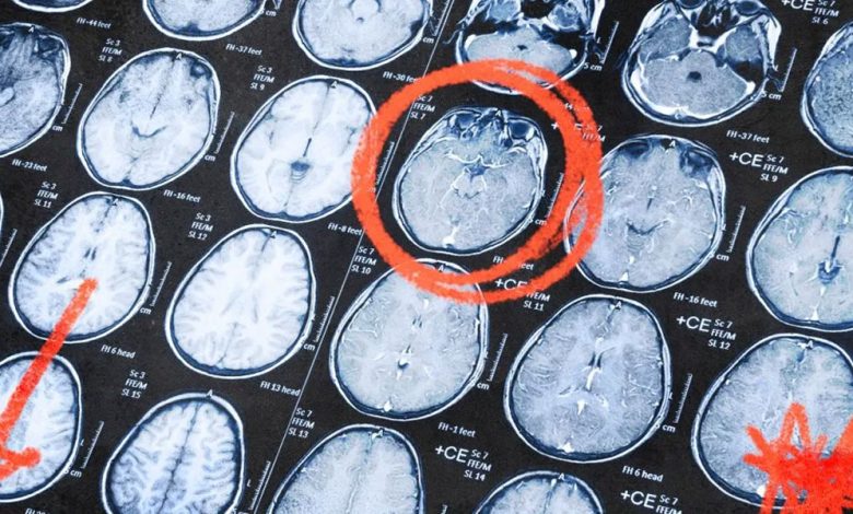 Neurologists Discover That Parkinson’s is Actually Two Diseases