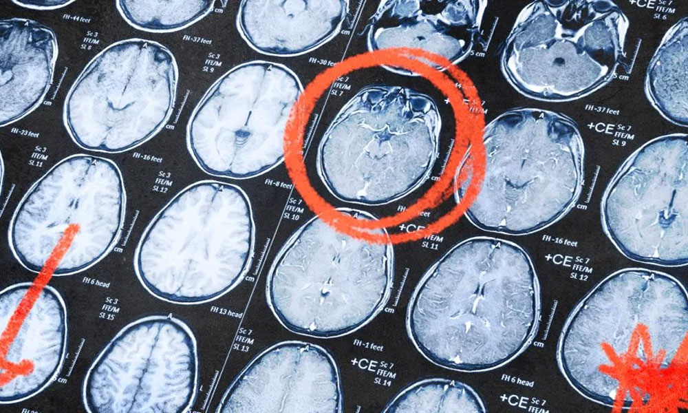 Neurologists Discover That Parkinson’s is Actually Two Diseases