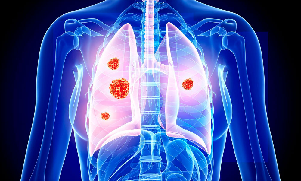 12 Early Signs Of Lung Cancer To Never Ignore