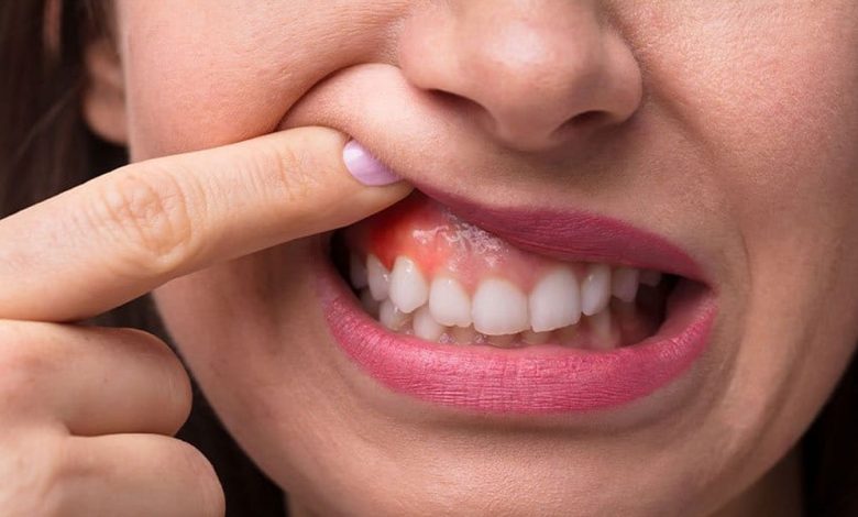 5 Types of Periodontal Disease Never to Ignore