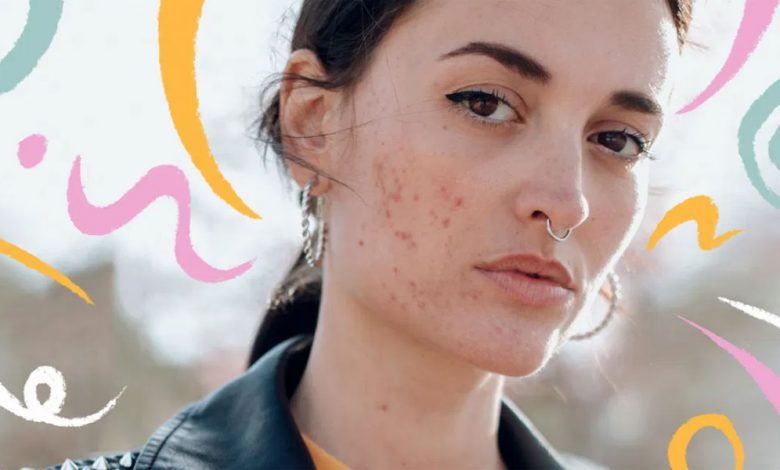 Dermatologists Explain Stress Acne and 3 Ways to Fix It