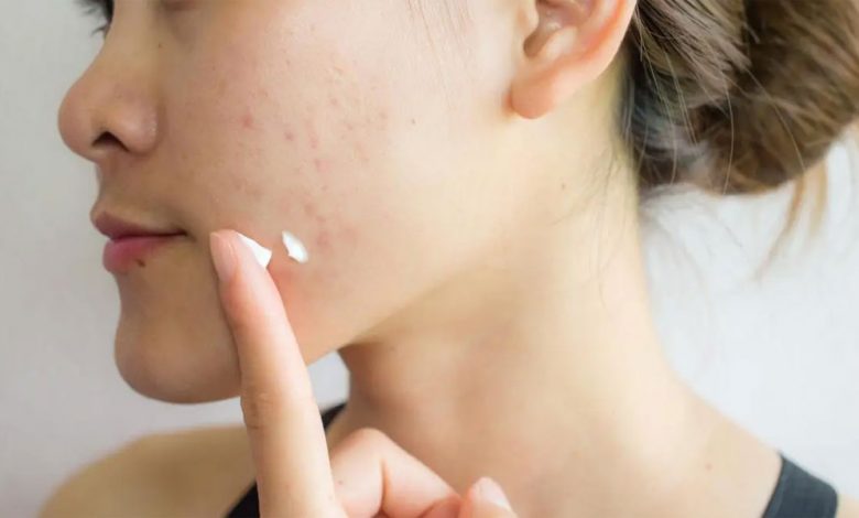 How To Treat Acne And Marks And Get Clear Skin