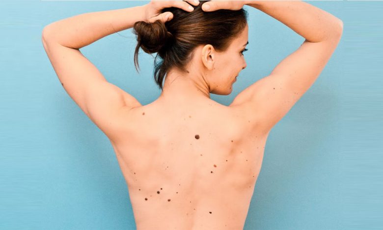 Are Moles On Body A Serious Health Problem